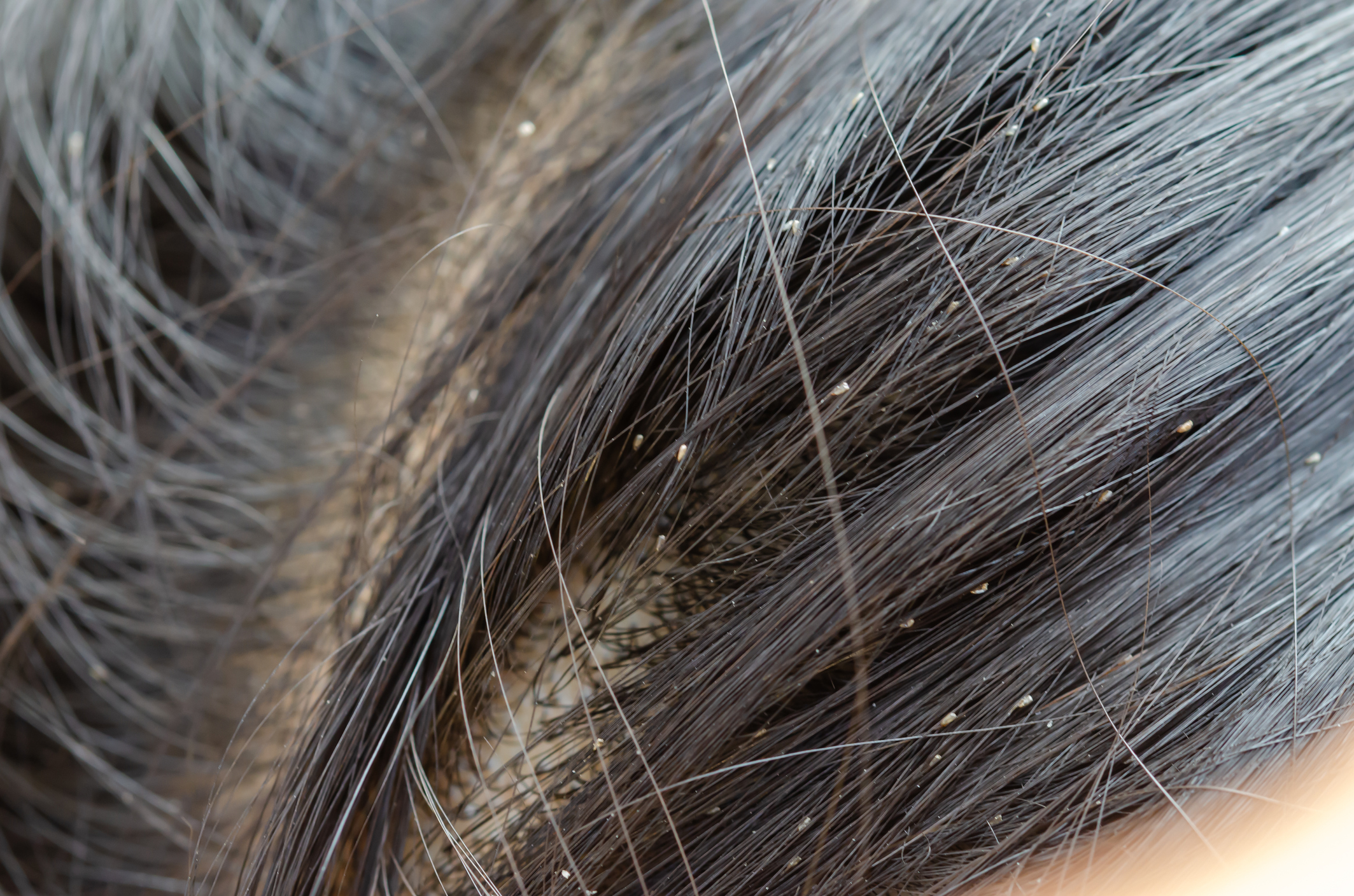Picture of nits in hair